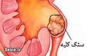 عامل اصلی درمان سنگ کلیه چیست؟ مجله سلامت متخصص کلیه و مجاری ادرار درمان سنگ کلیه