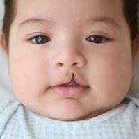 شیوع شکاف لب در مناطق محروم