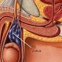 چند روش ساده طب سنتی برای درمان «واریکوسل»