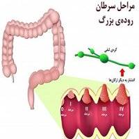 نوعی بیماری که باید هر سه سال آزمایش خون مخفی داد