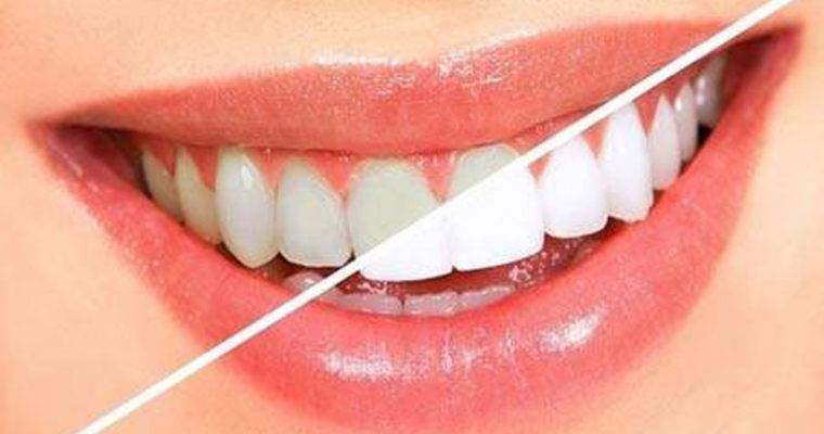 استفاده از پودرهای سفید کننده دندان مضر است