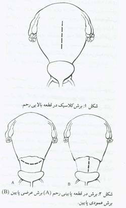 زایمان به طریق سزارین