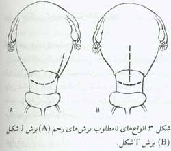 زایمان به طریق سزارین