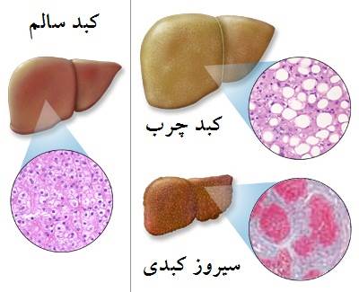 کبد چرب از دیدگاه طب سنتی(1)