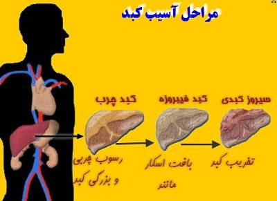 کبد چرب از دیدگاه طب سنتی(1)