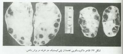 بیماریهای تخمدان و لوله های رحمی چیست؟(1)