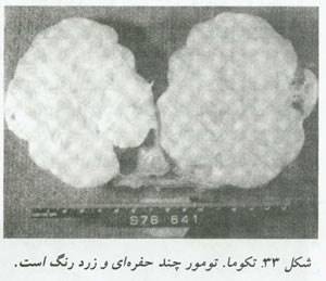 بیماریهای تخمدان و لوله های رحمی چیست؟(1)