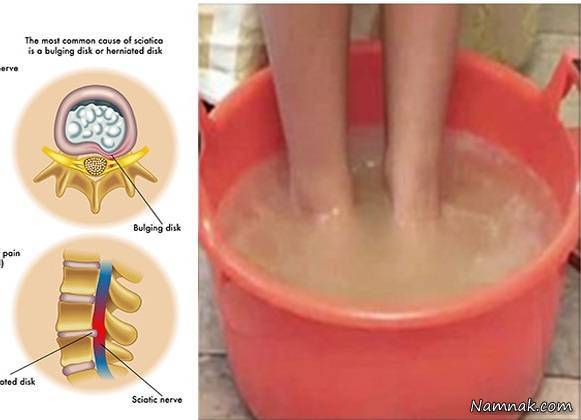تسکین درد سیاتیک 