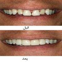 کامپوزیت دندانی چیست؟