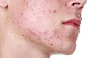 جوش یا بثورات پوستی در اثر آلرژی به مواد غذایی