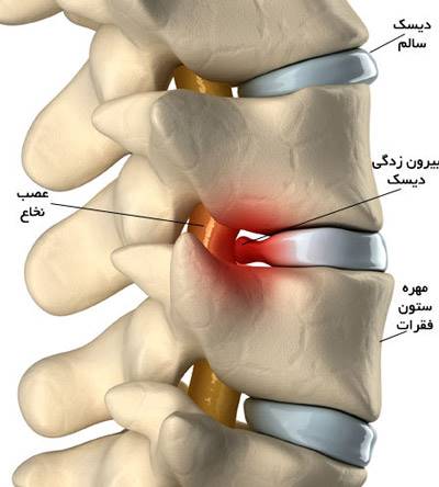 دیسک یا سیاستیک؟ مساله این است؟