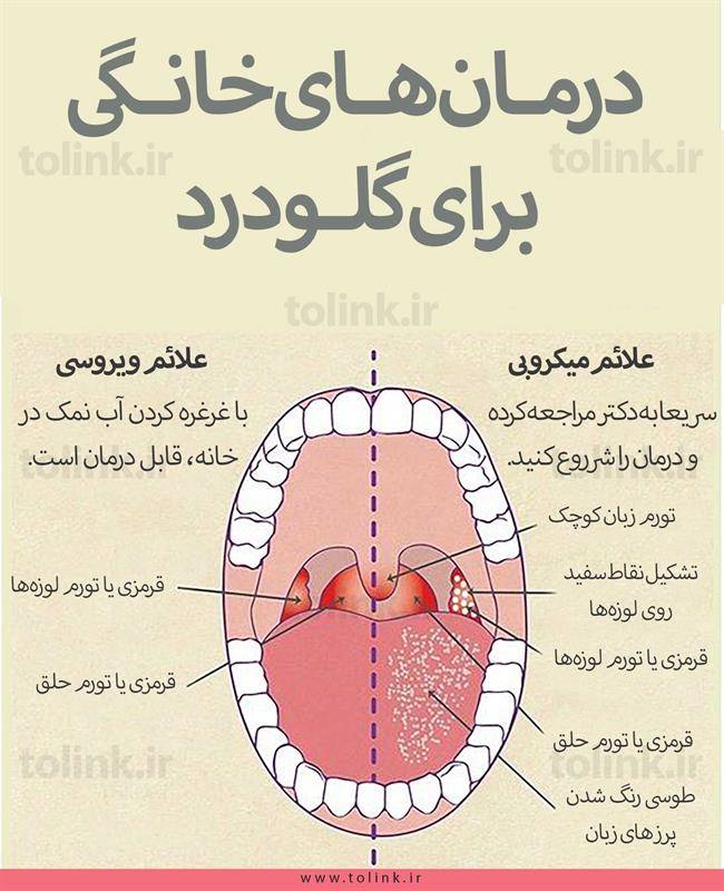 درمان خانگی گلودرد