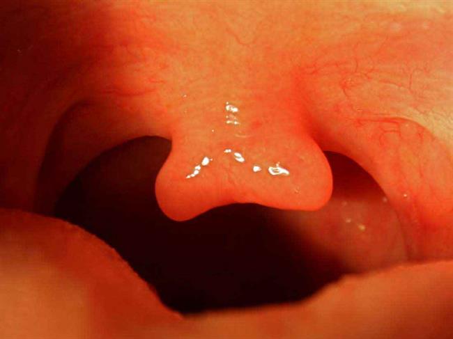 زبان کوچک دو شاخه bifid uvula