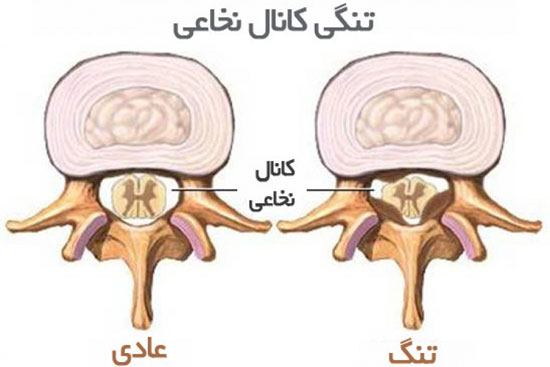 علل، علایم، عوامل خطرساز و راه‌های تشخیص و درمان تنگی کانال نخاع؛ به بهانه جراحی اخیر مسعود کیمیایی کارگردان سرشناس سینمای ایراندرباره تنگی کانال نخاع