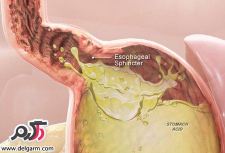 درمان ریفلاکس معده با طب سنتی