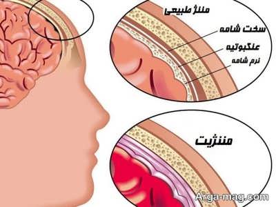 مننژیت چیست؟