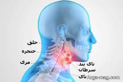 هر آنچه لازم است از سرطان حنجره بدانید