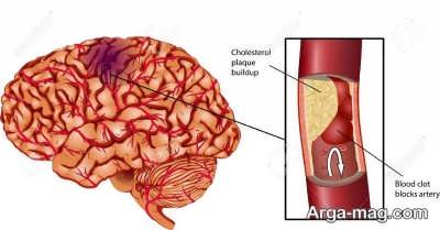 علایم و نشانه سکته مغزی ایسکمیک