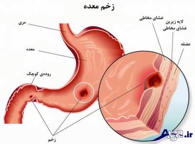 نشانه های زخم معده