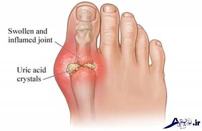 بیماری نقرس و روش های درمان آن 