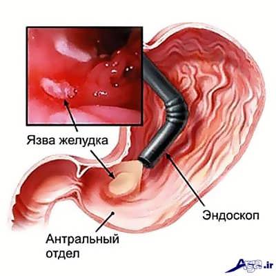 علایم و نشانه های خونریزی معده 