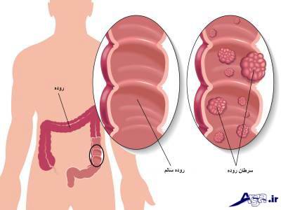 علائم سرطان روده