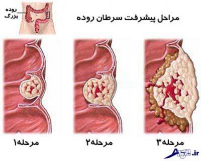 سرطان روده