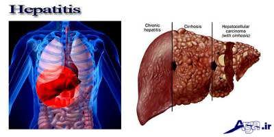 علایم هپاتیت