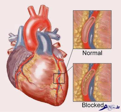 رگ قلب و گرفتگی آن