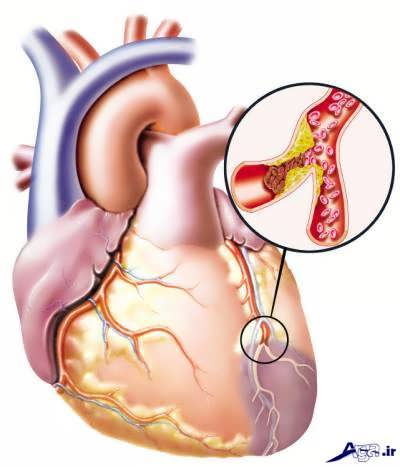 گرفتگی رگ های قلب