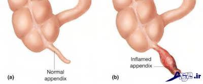 آپاندیس و علائم آن