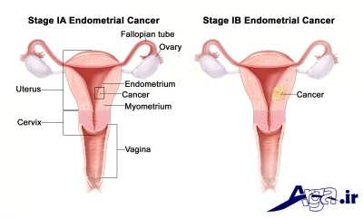 علائم و پیشگیری از سرطان رحم