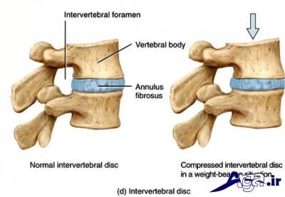 نشانه ها و علایم دیسک کمر