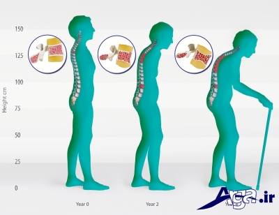 علایم پوکی استخوان 