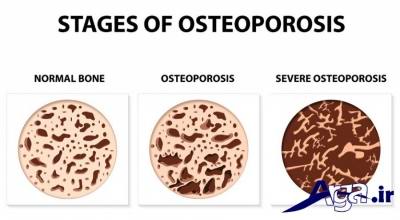 درمان پوکی استخوان