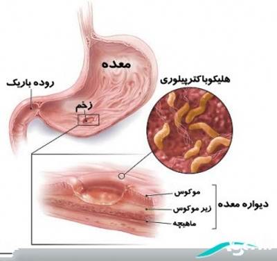 بیماری های معده 