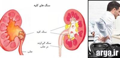 علایم سنگ کلیه