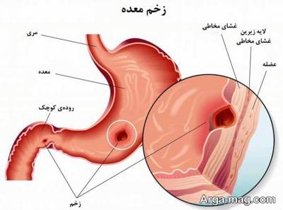 با این روش ها زخم معده را در منزل درمان کنید