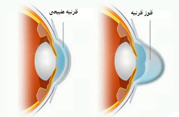 همه چیز درباره بیماری قوز قرینه (کراتوکنوس) و روشهای درمان آن