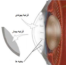 همه چیز درباره بیماری قوز قرینه (کراتوکنوس) و روشهای درمان آن