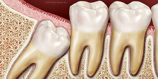کشیدن دندان عقل موجب مرگ می شود؟