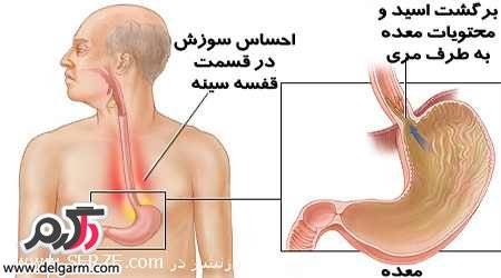 عوارض ترش کردن معده چیست؟