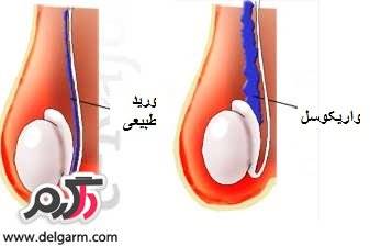  علایم واریکوسل چیست؟