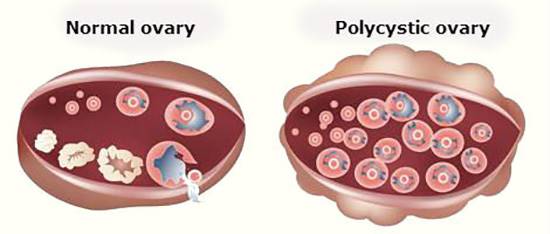 تخمدان پلی کیستیک ، زنان را نازا می کند؟