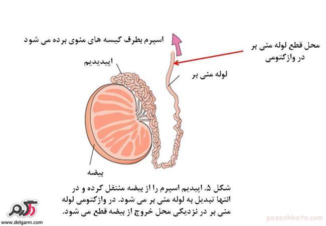 وازکتومی چیست؟و چه عوارضی دارد؟