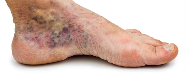 Diabetic foot