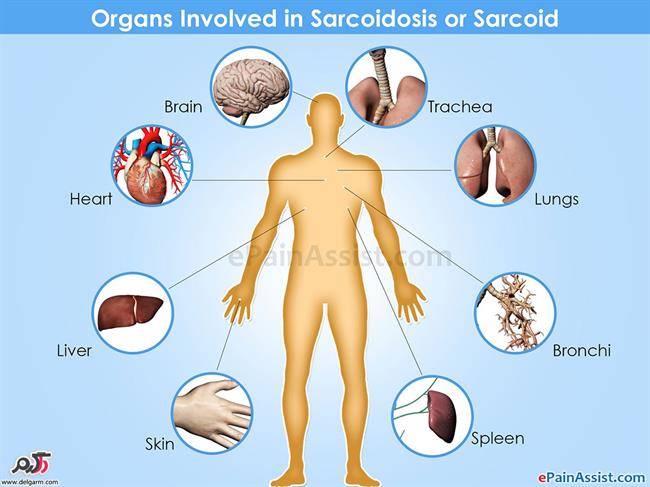 Sarcoidosis