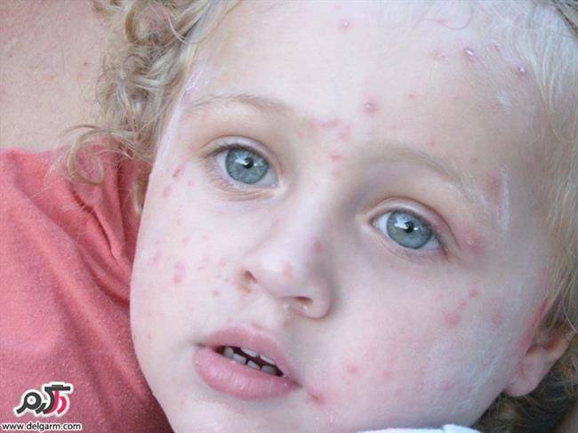 آبله‌ مرغان‌ chickenpox