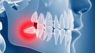 نکاتی برای تسریع بهبودی پس از جراحی دندان عقل