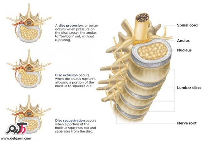 پارگی دیسک کمر